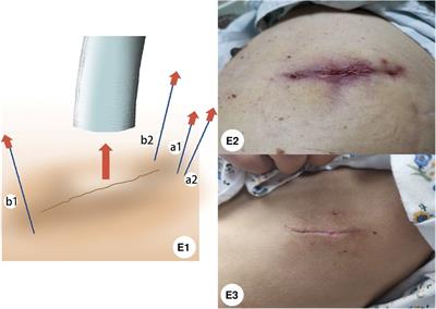 A New Traceless Technique for Cosmetic Closure of Minimally Invasive Incision and Chest Tube Fixation After Uniportal Video-Assisted Thoracoscopic Surgery